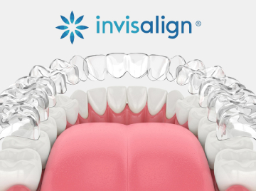 5 Ways Clear Aligners Support Long-Term Tooth Health